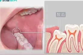 拔一颗智齿800百元，医生建议拔四颗！我的智齿到底该不该拔？图片