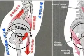 怎么自己检测一下骨盆歪了没有？有什么危害？怎么应对？图片
