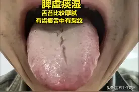 脾虚百病生！从舌象分辨脾虚轻重图片