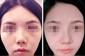 做完“五维分层微创鼻雕”才知道！手术能做到的，它居然也可以？图片