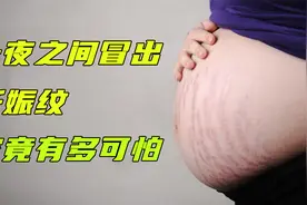 被隐藏的怀孕真相：妊娠纹是怎么形成的？为什么不能消除呢？视频封面
