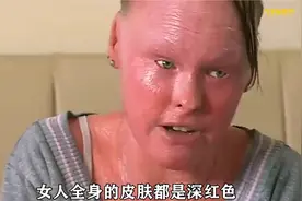 女人全身发红，每天在痛苦中煎熬#奇闻奇事 #怪事 #皮肤视频封面