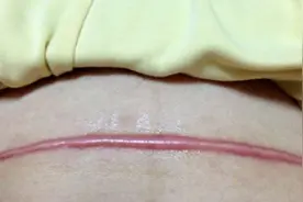 剖腹产疤痕速看！两个月去除疤痕完全实现！再也不做无用功！视频封面