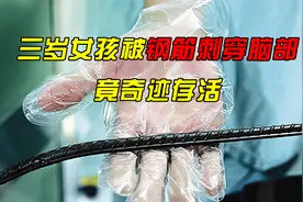 三岁女孩被30厘米钢筋刺穿脑部，竟奇迹存活！视频封面