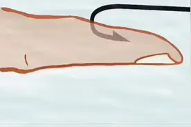 鱼钩扎到肉里，怎么取出来？教你一招，轻松解决视频封面