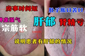 这样的舌象，肾虚、肝郁、脾虚，宗筋绵软，一个老方子补肾填精视频封面