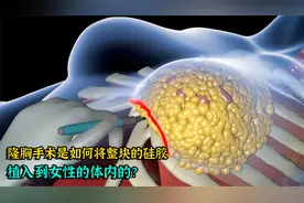 隆胸手术是如何将整块的硅胶，植入到人体里面的？视频封面