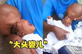 刚出生婴儿头大如筐，医院无法治疗，母亲整日以泪洗面。纪录片