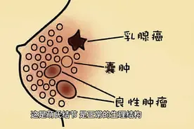 女生胸部一边大一边小正常吗？视频封面