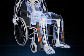 国外爆火的断骨增高术竟然是这样的！只需九个月就能增高15厘米