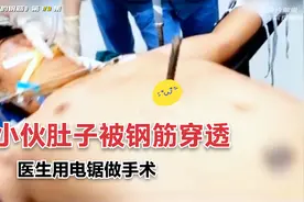 小伙被钢筋刺穿肚皮，医生用电锯做手术，一阵火花带闪电！视频封面