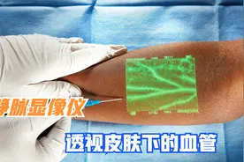 国外发明静脉显像仪，透视皮肤下的血管，新手护士也能一针扎中