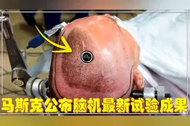 马斯克公布了脑机人机人体试验的最新结果，震惊整个医学界视频封面