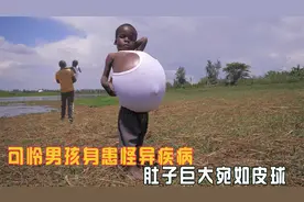 可怜男孩身患怪异疾病，肚子巨大宛如皮球视频封面