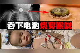 【误食电池】两小时就能烧损器官，等看到吐血基本没救