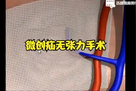 这个没有备胎，去医院给自己补了个胎（微创无张力腹股沟疝手术）视频封面
