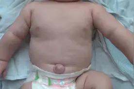 小宝宝的肚脐鼓起一个圆圆的肉球球，你知道这是怎么回事吗？视频封面