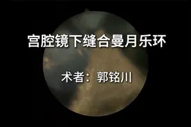 宫腔镜下曼月乐环缝合