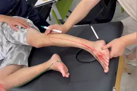 脚底麻木痛的处理视频封面