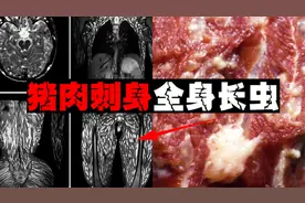 【猪绦虫病】生食猪肉后病痛全身，人体扫描呈星空状视频封面