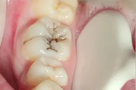 被吃空的蛀牙，一比一真实还原补牙过程，看得我魂飞魄散！