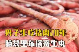 男子生吃猪肉20年，被寄生虫爬满脑袋，生食真的可以随便吃吗？视频封面