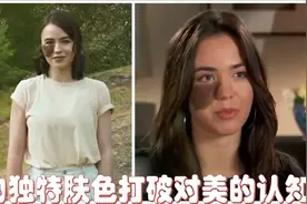 这位患有皮肤病的超模，她真正独特的肤色打破了人们对美的认知视频封面