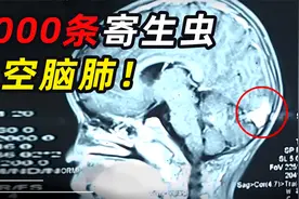 一顿烧烤，脑肺被吃空！男孩酷爱吃烧烤，体内生出5000条寄生虫视频封面