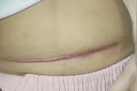 剖腹产疤痕增生还有救吗？过来人教你一招，在家解决顽固疤痕！