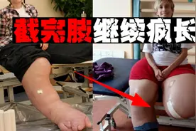 【无限巨腿】截肢后生长更加疯狂，罕见病女孩如何活出自我视频封面