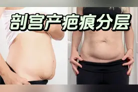 【剖腹产疤痕】肚子分层必备｜松解深层粘连视频封面