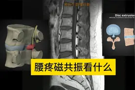 手把手教你腰痛磁共振看什么----2024-06-20视频封面