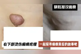 关于腹部瘢痕疙瘩的故事视频封面