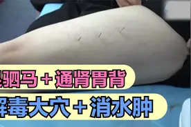 董氏奇穴实操“足驷马＋通肾通背痛胃”针对肤病＋全身水肿一绝！视频封面