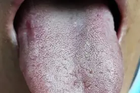 中医二羊：武汉大姐感染新冠后梅核气，失眠、胸闷气短、咽喉堵塞图片