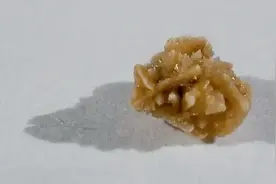 肾结石多大需要碎石 做手术到底好不好图片