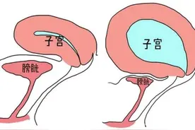 女生憋尿憋到黄体破裂？憋尿相当于一瓶可乐的水容量在膀胱内？图片
