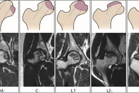 股骨头坏死临床诊疗技术专家共识（2022年）图片