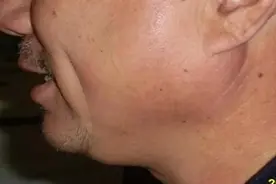 腮腺炎的症状图片图片