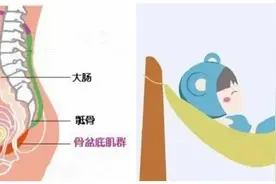 漏尿和子宫脱垂的前世今生图片
