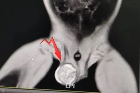 双胞胎兄弟“大小蛋”，为何一个保一个切？家长要警惕！图片