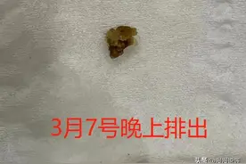 太高兴了，两粒肾结石，终于排出来了！太折磨人了。图片