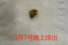 太高兴了，两粒肾结石，终于排出来了！太折磨人了。图片