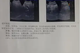 B超无回声、低回声、强回声、高回声是什么图片