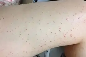 警惕！孩子身上突然出现小红点，可能是身体发出的“求救信号”图片