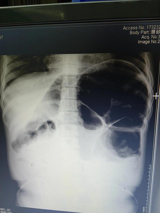 你不知道的肠梗阻"胀""吐""痛""闭"四大症状