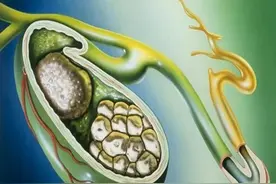 招飞体检因胆囊结石淘汰后怎么办？图片