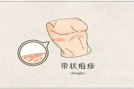 带状疱疹？！除了皮疹，疼痛更“缠人”！图片