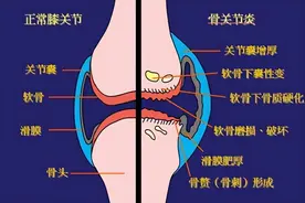 骨关节炎的几种止痛方法图片