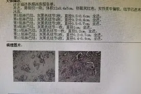 混磨迅速长大成实性结节，病理肺癌超预期，微乳头和淋巴结转移图片